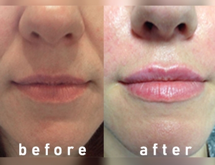 تصاویر قبل و بعد از تزریق ژل